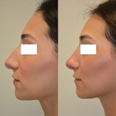 Rhinoplasty Before Patient 1