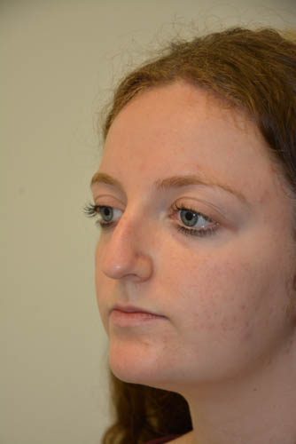 Rhinoplasty Before Patient 4