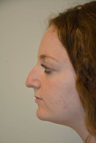 Rhinoplasty Before Patient 3