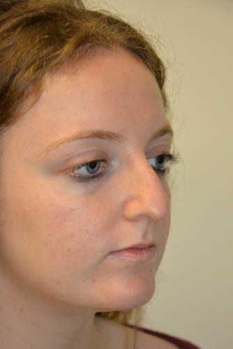 Rhinoplasty Before Patient 2