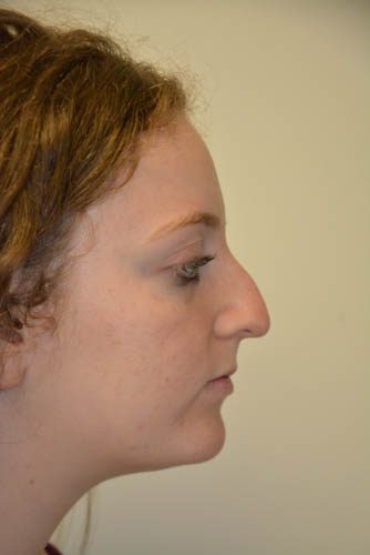 Rhinoplasty Before Patient 1