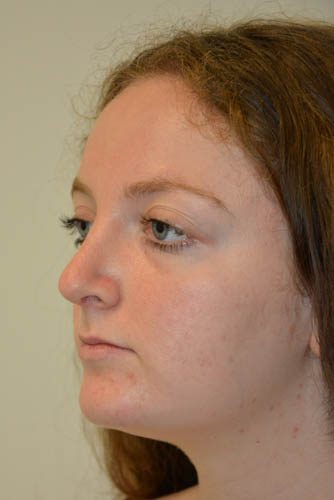 Rhinoplasty After Patient 4