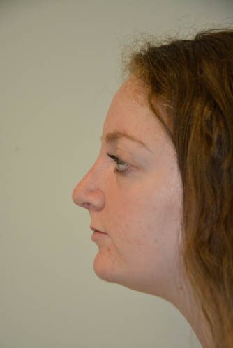 Rhinoplasty After Patient 3