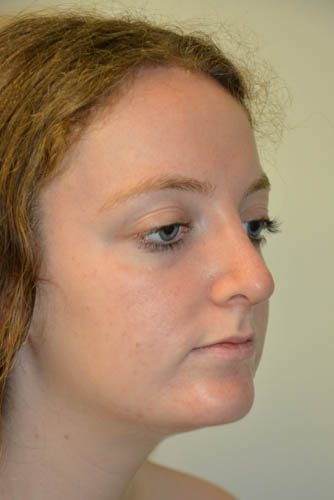 Rhinoplasty After Patient 2