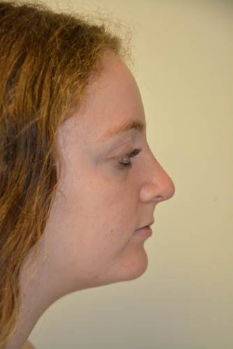 Rhinoplasty After Patient 1