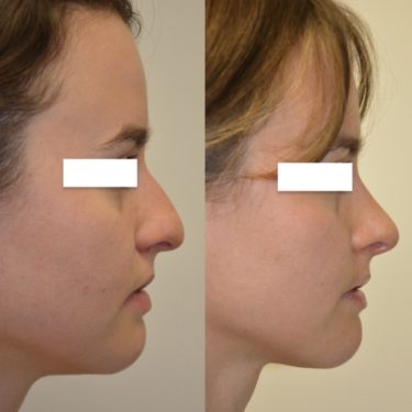 Rhinoplasty Before Patient 1