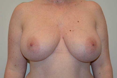 Breast Reduction Before Patient 1