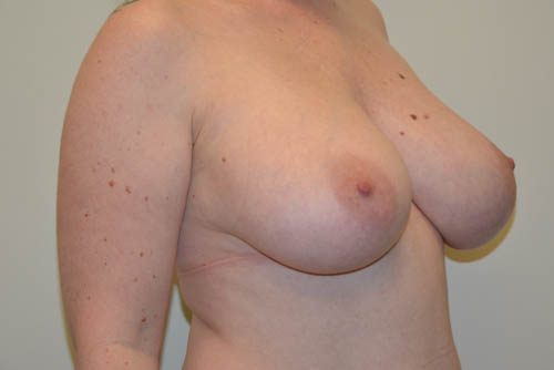 Breast Reduction Before Patient 2