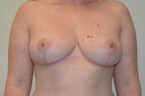 Breast Reduction After Patient 1