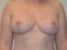 Breast Reduction After Patient Thumbnail 1