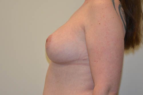 Breast Reduction After Patient 5