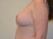 Breast Reduction After Patient Thumbnail 5