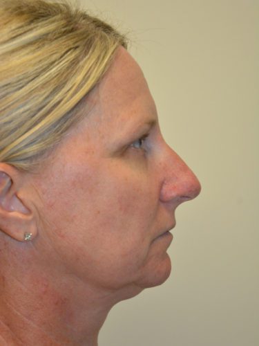 Rhinoplasty Before Patient 3