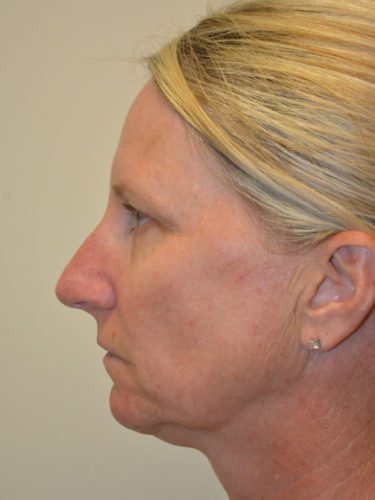 Rhinoplasty Before Patient 5