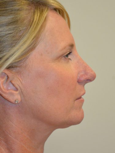 Rhinoplasty After Patient 3