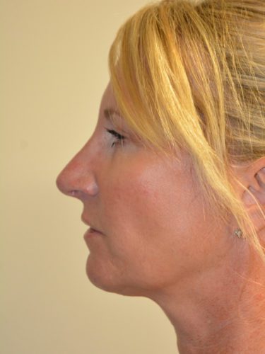 Rhinoplasty After Patient 5