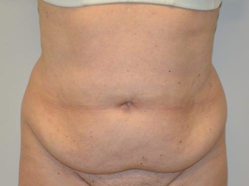 Tummy Tuck Before Patient 1