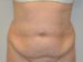 Tummy Tuck Before Patient Thumbnail 1