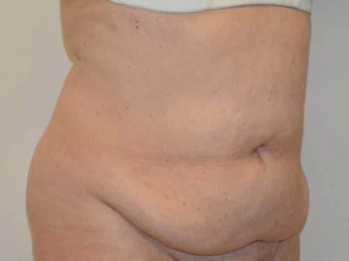 Tummy Tuck Before Patient 2