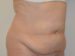 Tummy Tuck Before Patient Thumbnail 2