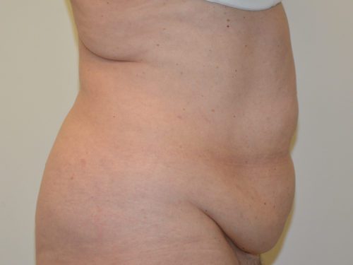 Tummy Tuck Before Patient 3