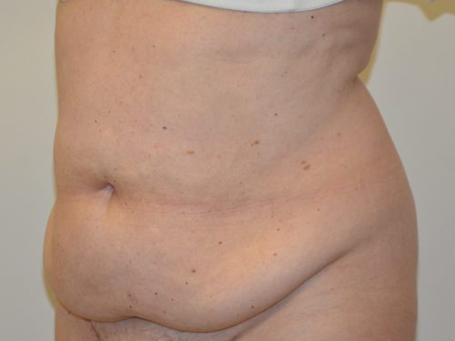 Tummy Tuck Before Patient 4