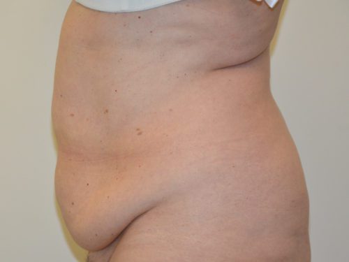 Tummy Tuck Before Patient 5