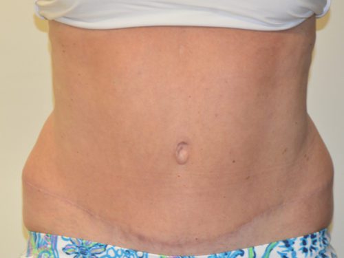 Tummy Tuck After Patient 1