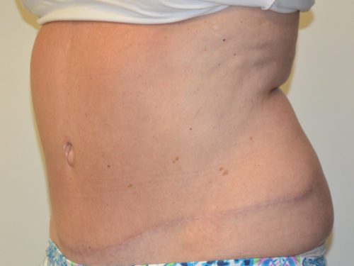 Tummy Tuck After Patient 4