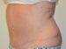 Tummy Tuck After Patient Thumbnail 4