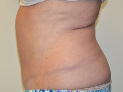 Tummy Tuck After Patient 5