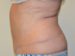 Tummy Tuck After Patient Thumbnail 5