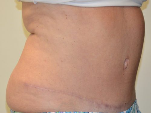 Tummy Tuck After Patient 2