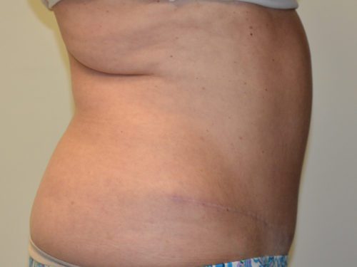 Tummy Tuck After Patient 3