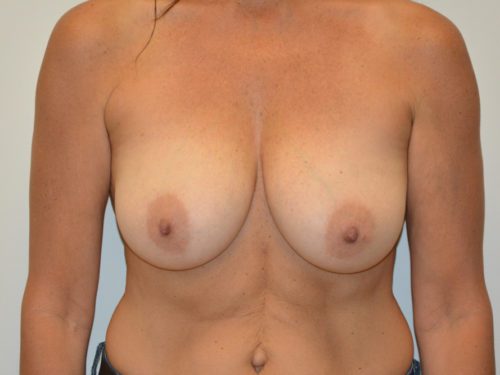 Breast Reduction Before Patient 1