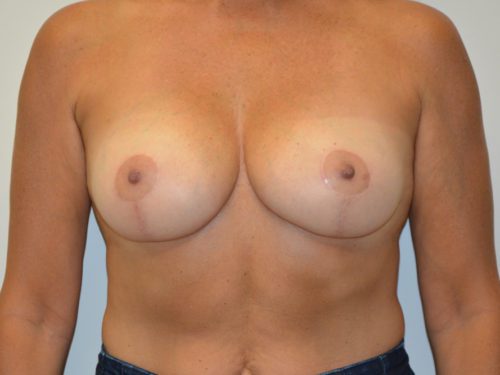 Breast Reduction After Patient 1