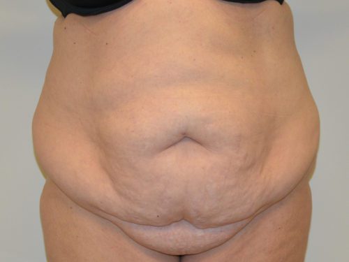 Tummy Tuck Before Patient 1