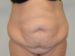 Tummy Tuck Before Patient Thumbnail 1