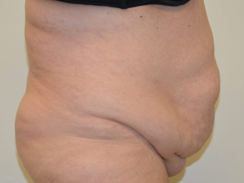 Tummy Tuck Before Patient 5