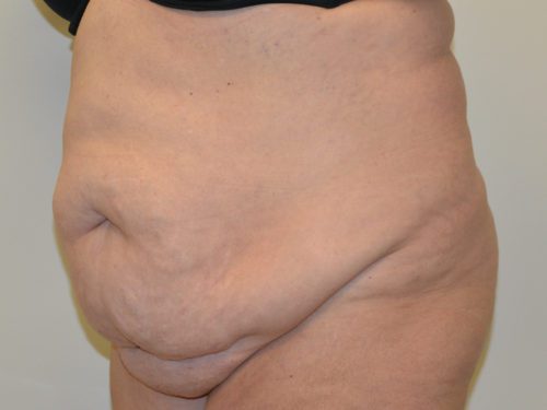 Tummy Tuck Before Patient 2