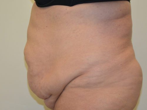 Tummy Tuck Before Patient 3