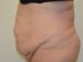 Tummy Tuck Before Patient Thumbnail 3