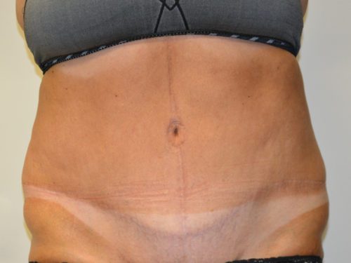 Tummy Tuck After Patient 1