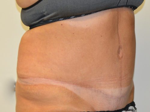 Tummy Tuck After Patient 4