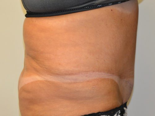 Tummy Tuck After Patient 5