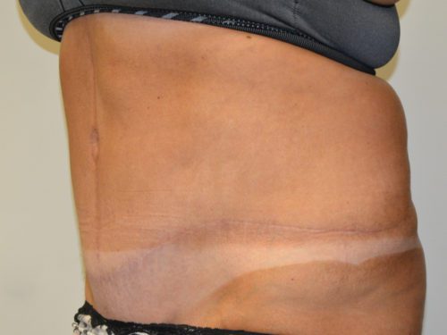 Tummy Tuck After Patient 2