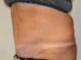 Tummy Tuck After Patient Thumbnail 2