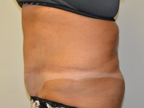 Tummy Tuck After Patient 3