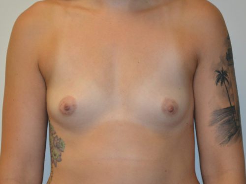 Breast Augmentation Before Patient 1