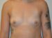 Breast Augmentation Before Patient Thumbnail 1